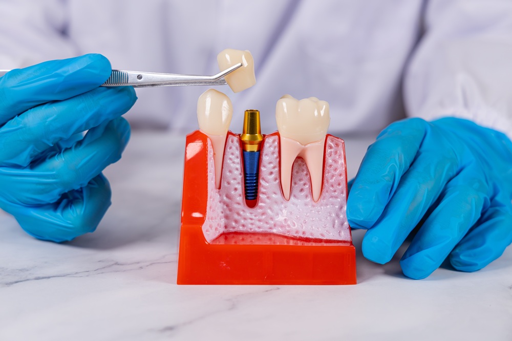 How a Dental Implant Restoration Attaches to the Implant Post Dentist demonstrating how a dental crown attaches to an implant post